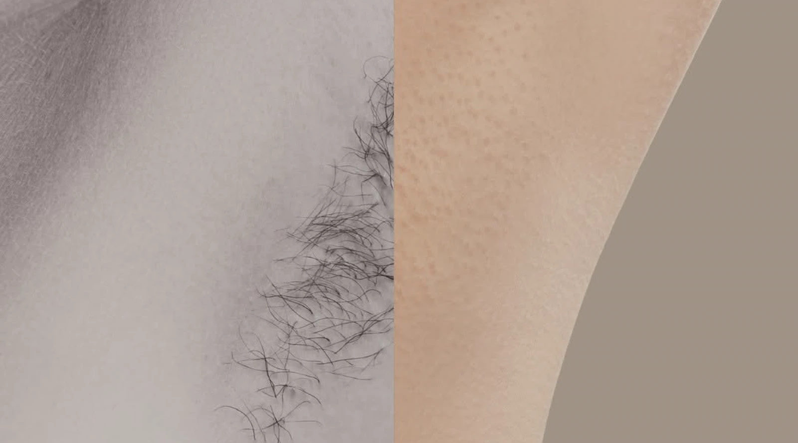 Real Bella Brazil underarm laser hair removal before and after result